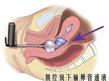 ��ǻ�������ѹ�ͨҺ